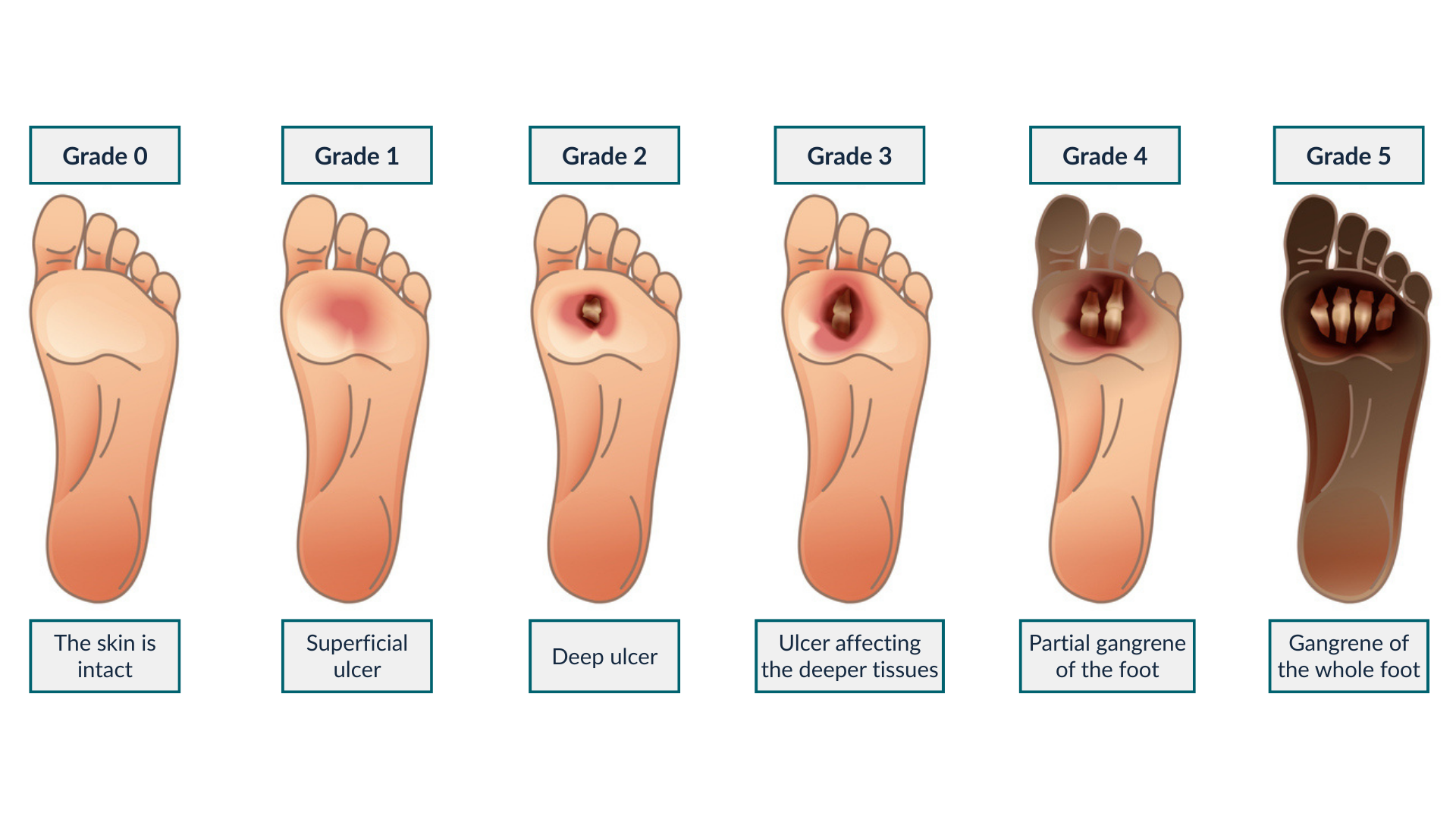 was-my-diabetic-foot-ulcer-treatable-diabetic-ulcer-stages-legal